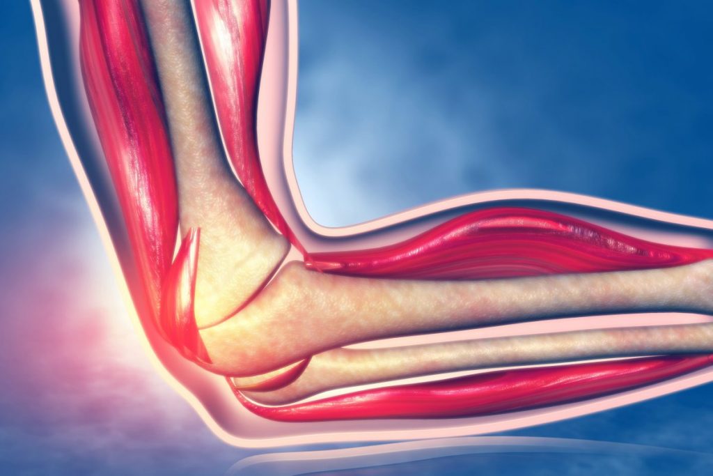 epicondylitis